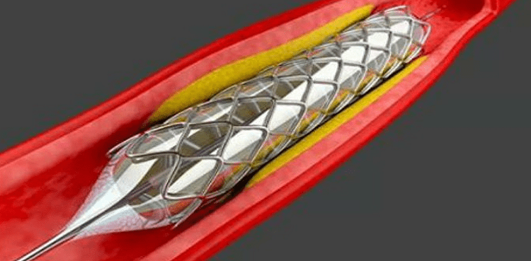 local-cardiac-stent