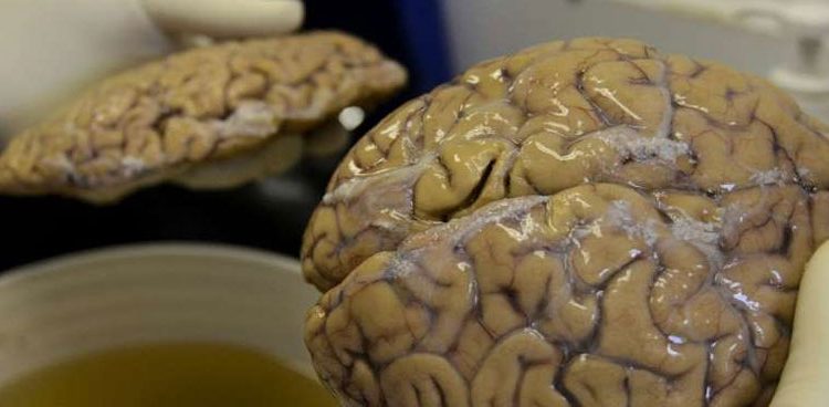 severe-covid-19-can-damage-the-brain