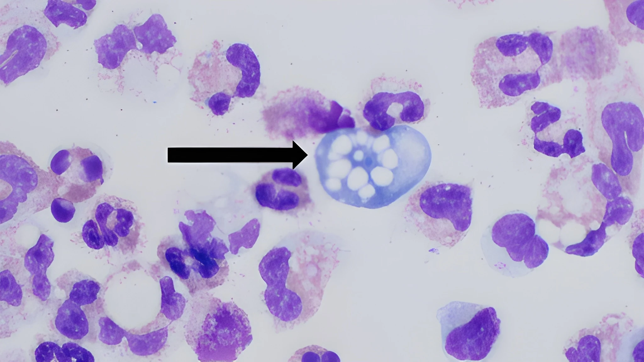 Third Naegleria death reported in Karachi