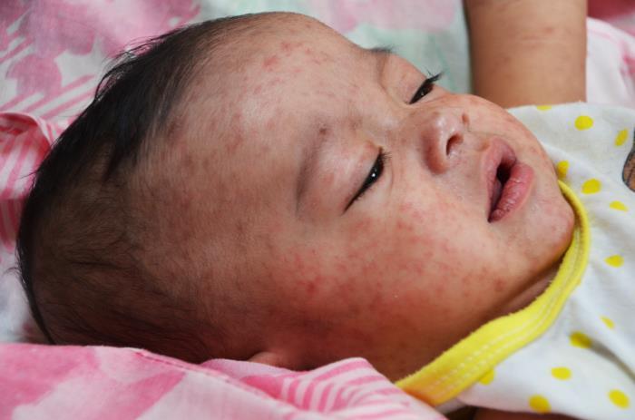 measles-outbreak-in-chaman-leaves-three-children-dead